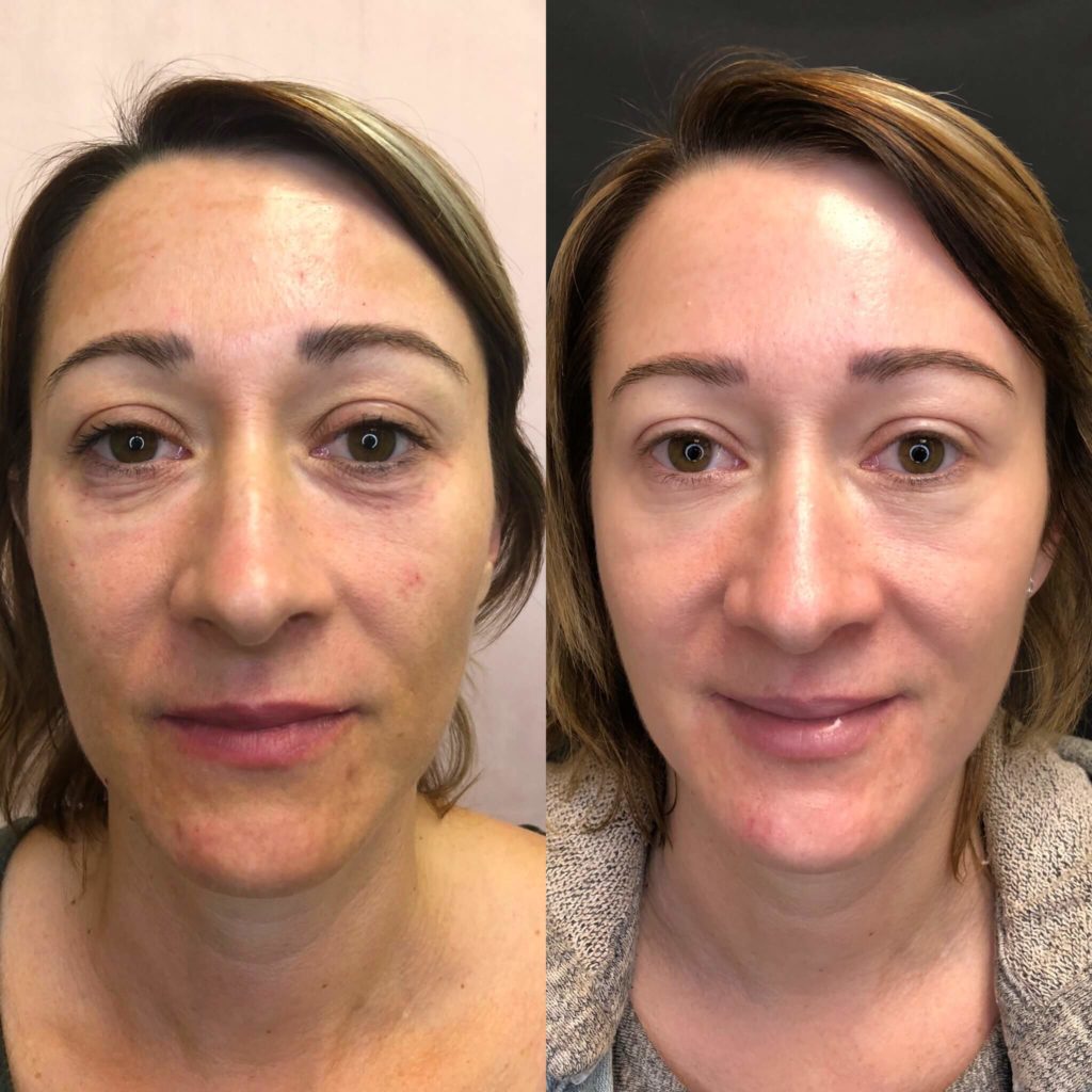 Integratore Antiage con Collagene Idrolizzato e Vitamina C